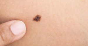 Simplest Ways To Conceal Your Birthmark