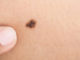 Simplest Ways To Conceal Your Birthmark