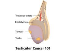 Testicular Cancer 101