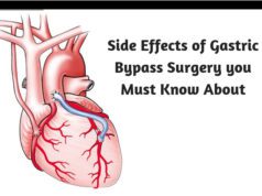 Side Effects of Gastric Bypass Surgery you Must Know About