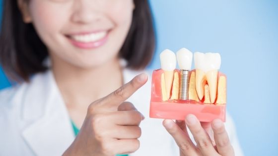 7 Important Reasons Why Dental Implants are the Best Choice for Replacing Missing Teeth