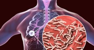 What is Tuberculosis? Types symptoms and prevention