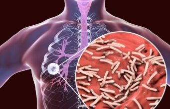 What is Tuberculosis? Types symptoms and prevention